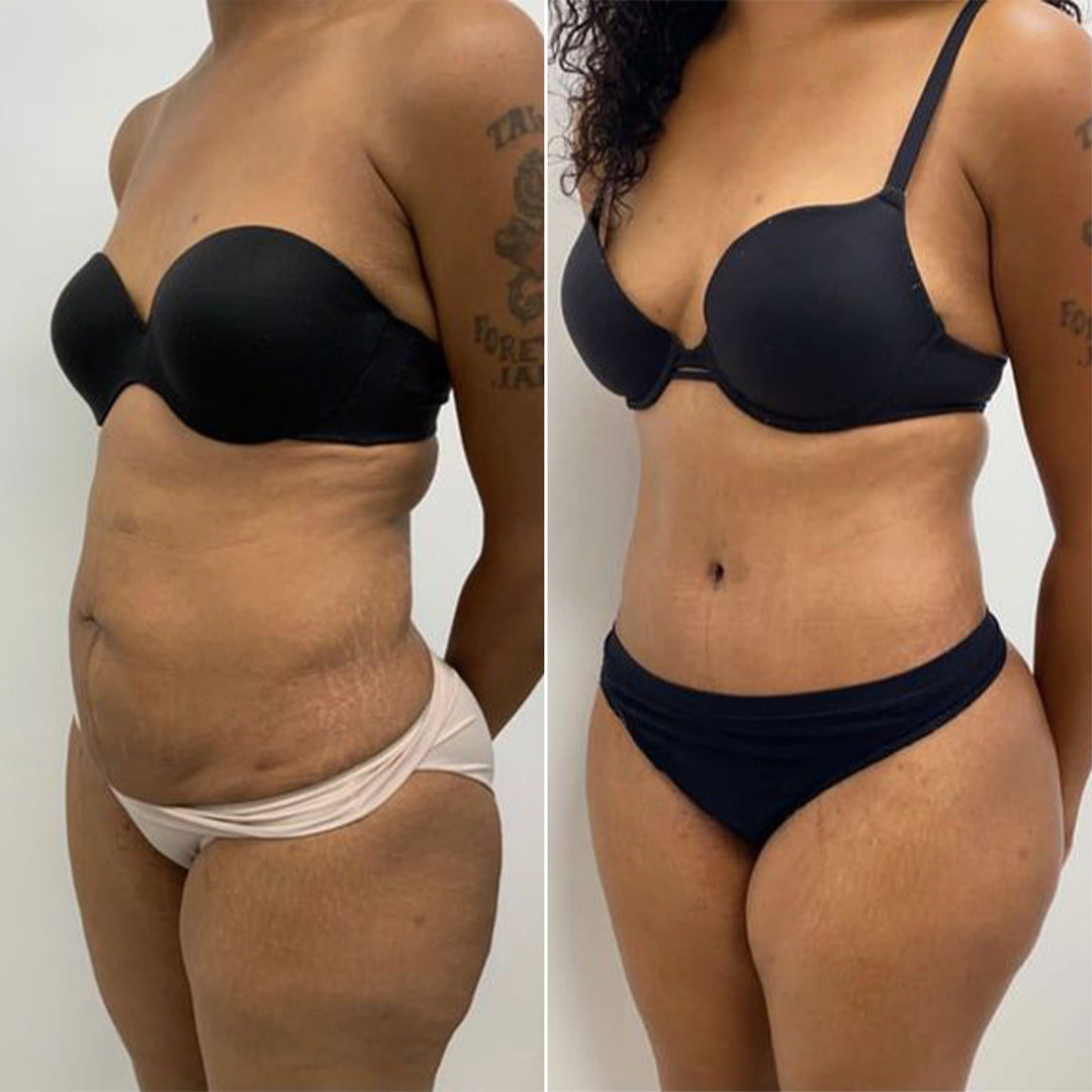 sculpt touch glp-1 reviews before and after Before and after customer results reviews – Nordic Sculpt sculpt touch glp-1 reviews before and after Before and after customer results reviews – Nordic Sculpt